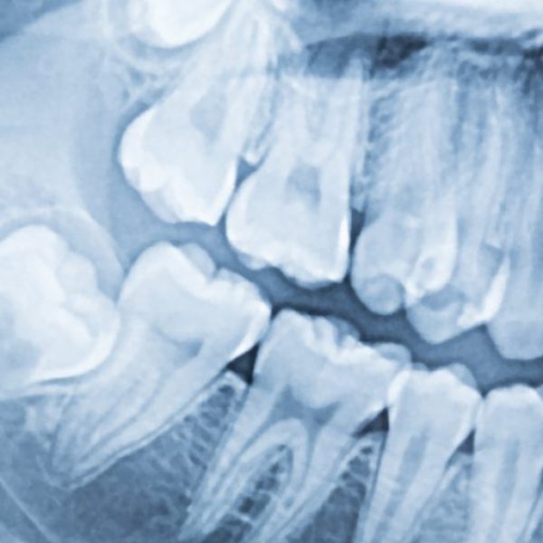 panoramic-dental-x-ray-mouth-left-right-side-1-768x512